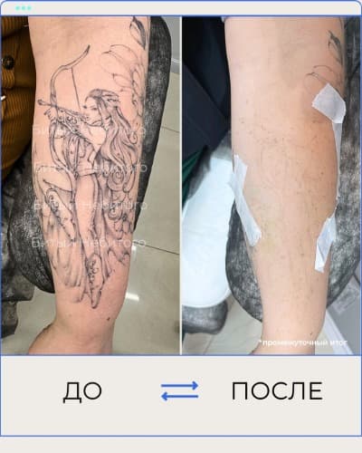 Удаление татуировки